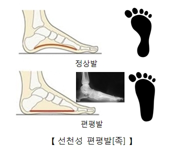 선천성 편평발